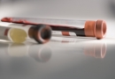 Sustabdyti hepatito plitimą padėtų griežtesnė donorų kraujo kontrolė