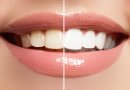 Populiariausi mitai apie dantų balinimą