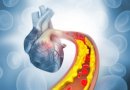Kardiologė pataria, kaip patiems įsivertinti cholesterolio tyrimus