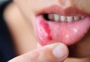 Žaizdelės burnoje: kodėl jos atsiranda?