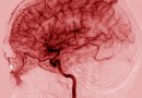 Ilgalaikis galvos smegenų kraujotakos nepakankamumas: kaip to išvengti?