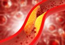 Sukluskite: šie 6 ženklai išduoda aukštą cholesterolio kiekį kraujyje
