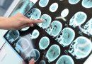 Mokslininkai nustebę: atskleidė, kas turi didesnę riziką susirgti Alzheimeriu