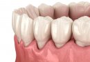 Dažniausia dantų netekimo priežastis: dėl šios ligos kreipiasi vis jaunesni pacientai