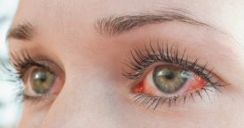 Įspėja neignoruoti akių perštėjimo: išduoda pavojingą ligą